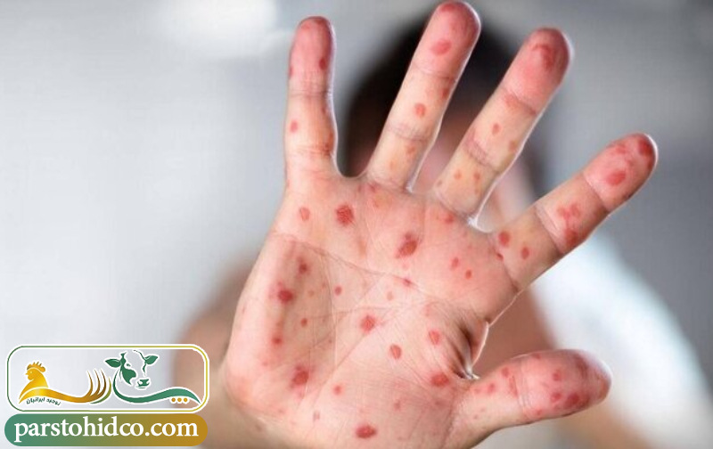 آبله در انسان (Smallpox) 