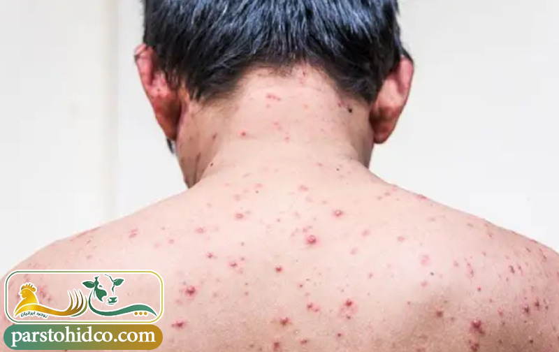 راه‌ های انتقال آبله انسانی 